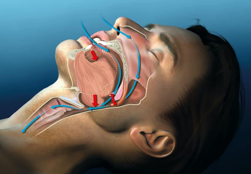 Causes Of Sleep Apnea and 3 Possible Treatments
